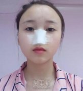 百达丽沈国雄鼻子案例，就此告别塌鼻子! width=