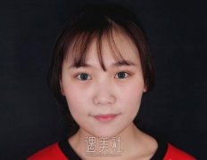 北京八大处鼻部手术案例展示|这还是我吗? width=