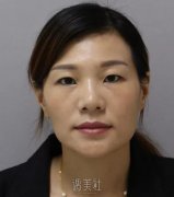 李战强鼻修复案例展示|看了我也想做! width=