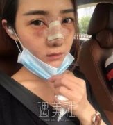 米兰陈倩鼻部手术果如何?案例及果图展示! width=