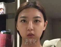 南宁东方整形垫下巴案例|整个脸型都变了! width=
