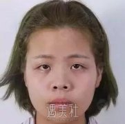 周长兵隆鼻案例分享|技术确实较为好! width=