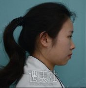 华美徐文龙隆鼻案例：真实恢复体验对比图~ width=