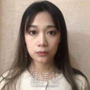 华美张鹏肋软骨隆鼻案例：半年前后对比照片~ width=