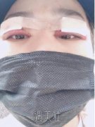 上海华美侣同帅双眼皮修复案例：从新获得真正的大眼睛~ width=