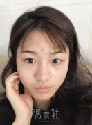 上海华美杨亚益做芭比双眼皮案例：前后恢复过程图分享~ width=