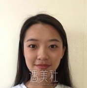 上海华美张朋网红眼部手术案例：99天前后对比分享图~ width=