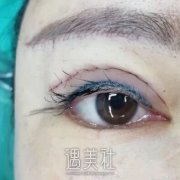 徐晓斐双眼皮修复案例：真实恢复体验对比图~ width=