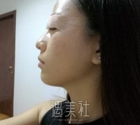 张余光修复双眼皮案例：74天眼睛发生惊人变化~ width=
