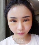 周慧芳双眼皮修复案例：真实恢复对比图~ width=