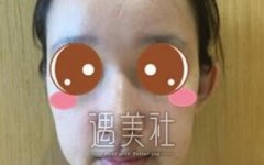 刘志刚隆鼻案例；终于找到了男朋友 width=