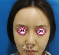南京李俊隆鼻案例:较为的适合我 width=