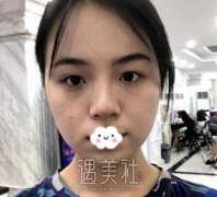 钱文江双眼皮案例:不用再为眼妆而发愁了 width=