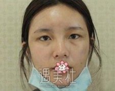 任冲双眼皮案例:跟原来的我感觉真是变了好多 width=