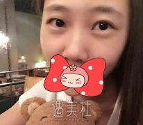 崔永言双眼皮案例：变大眼睛后心里美滋滋~ width=