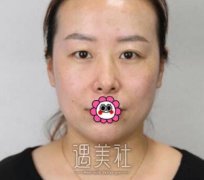 何冬梅双眼皮案例：趁年轻就要去变美~ width=