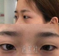 何冬梅双眼皮的案例：终于成为上相美女啦~ width=