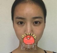 天津坤如玛丽双眼皮怎么样？案例有吗？ width=