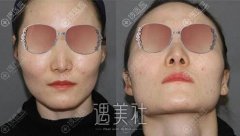 这是我花12万价格找北京圣嘉新医院张笑天做颧骨颧弓整形案例~ width=