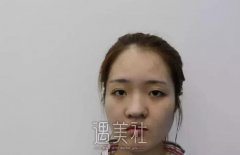 八大处王克明隆鼻案例|就此改变人生! width=