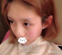 百达丽徐晓雯隆鼻案例|恢复90天果图展示 width=