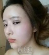 陈文双眼皮案例|完全看不出手术痕迹! width=