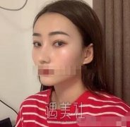 杨亚益双眼皮案例|终于能变成想要模样了! width=