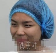 余东修复双眼皮案例分享|技术是真的好! width=
