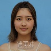 王克明隆鼻案例：术前术后恢复过程分享~ width=