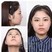 刘志刚隆鼻案例：感觉还不错 width=