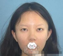任冲双眼皮案例：感觉比较不错很适合我 width=