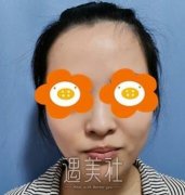 南京李俊隆鼻案例：形状较为的好看 width=
