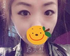 钱文江双眼皮案例 终于不用再为眼妆而发愁了 width=