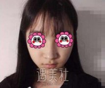 师俊莉隆鼻案例:自拍的时候再也不用找角度了 width=