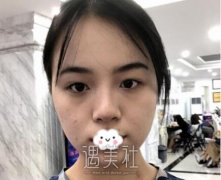 苏薇洁双眼皮案例:整个人看着都精神多了 width=
