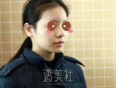 上海九院王健隆鼻案例:恢复的特别好 width=