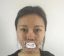 王永辉双眼皮修复案例分享，附术后15天恢复图~ width=