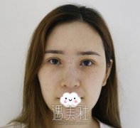 上海九院陈付国做鼻子案例：这才是鼻子理想的状态！ width=