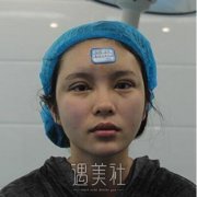 上海九院张余光双眼皮案例|果较为理想! width=