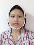 穆雄铮医生磨颧骨案例|面相瞬间得到了改变! width=