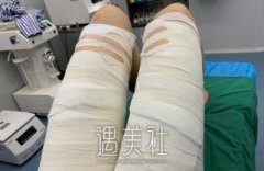 北京润美王明利吸脂案例|致产后的我! width=