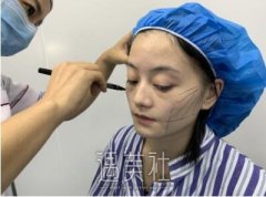 孙玮骏埋线提升案例|变美再也不是梦! width=