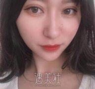 韩勋双眼皮案例|追到了心中男神! width=