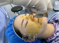 田秋梅隆鼻案例展示，技术确实很不错! width=
