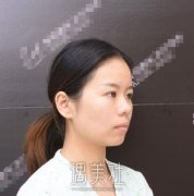 海医悦美常冬青隆鼻案例|果较为满意! width=