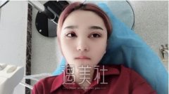 海医悦美林勇双眼皮案例|我也能睁眼看世界了! width=
