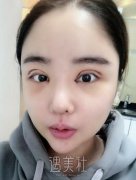 北京美莱杜园园双眼皮案例展示|果真的很不错! width=