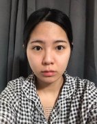北京美莱欧阳春鼻修复案例|拥有了人见人爱的鼻子! width=