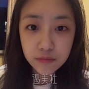 杨小顺双眼皮修复案例|重新恢复自信! width=