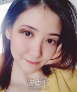 张昕霞双眼皮修复案例|还能恢复以前的果吗? width=
